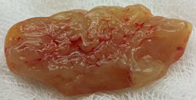 pbaleixo's tweet photo. #schneiderian #papillomas #inverted #endophytic #gross #ENTpath @GeronimoJrLapac @chioseasi @JMGardnerMD @kriyer68 https://t.co/rgHoSxaaoK