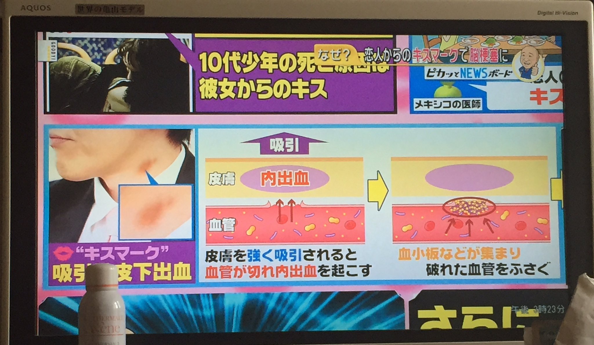 ぷにちゃん Punirua Pa Twitter キスマーク は危ないです 下手したら脳梗塞で死ぬらしいよ 笑 思わずニュースに食いついた 独占欲所じゃない 笑 Https T Co Nasgkpivmt Twitter