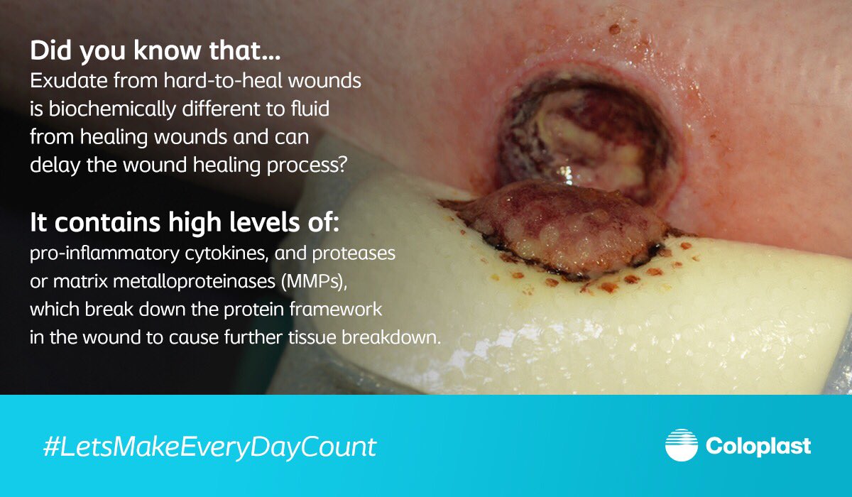 Coloplast_WCare's tweet image. 🤔 Did you know that exudate from hard-to-heal wounds is different than fluid from healing wounds? #woundcare #wuwhs