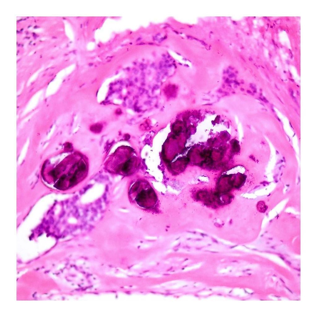 "Calcium Phosphate in Focus" ... 1 of 3 ... #pathology #breastpathology #breast #histology… ift.tt/2clWZID