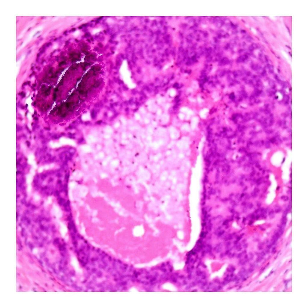 "Calcium Phosphate in Focus" ... 2 of 3 ... #pathology #breastpathology #breast #histology… ift.tt/2c6nZJQ