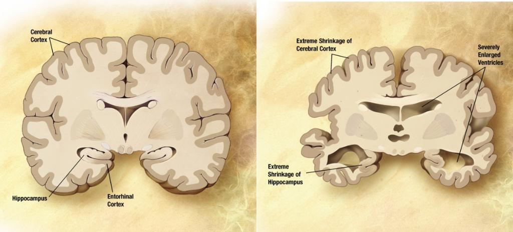ForbesTech's tweet photo. Research on protein blocking at the synapse shows Alzheimer's memory loss may be reversible: https://t.co/IUpp6YU88n https://t.co/x3FTG1NCq3