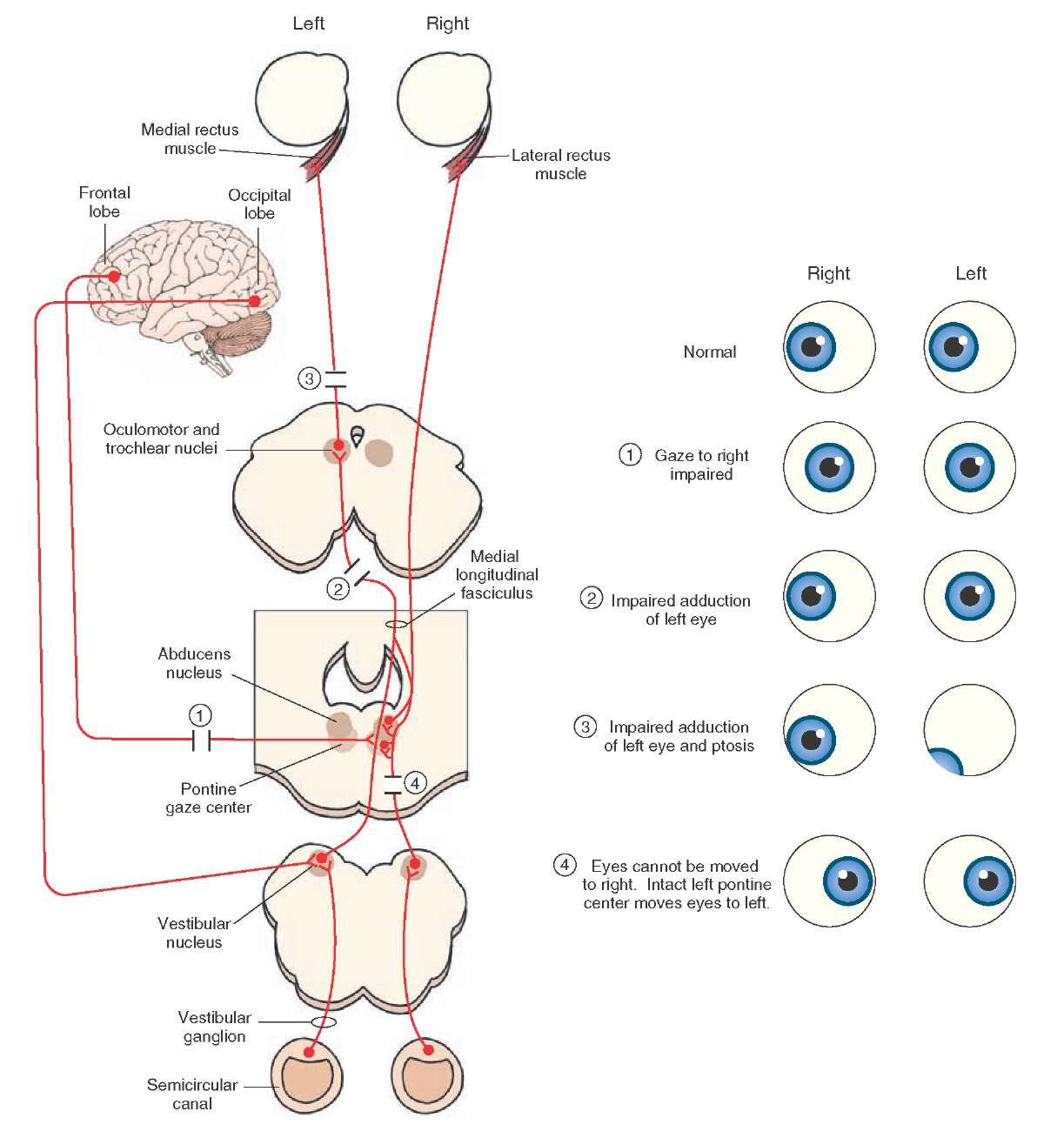 Horizontal gaze palsy