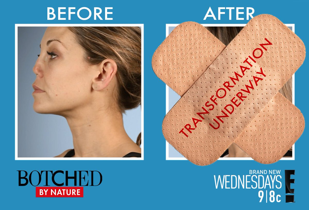 BotchedTV's tweet photo. Catch this amazing transformation on #BotchedByNature tomorrow, followed by Botchedβs Most Outrageous Patients at 10:30/9:30c on E! https://t.co/JSAkCpy37o