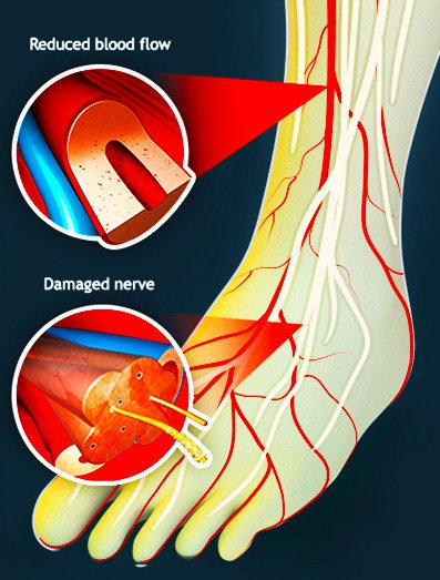 HealthCleveland's tweet photo. What you need to know about diabetic nerve pain https://t.co/O4FnaSUCh0 https://t.co/gY95EhI6Ae