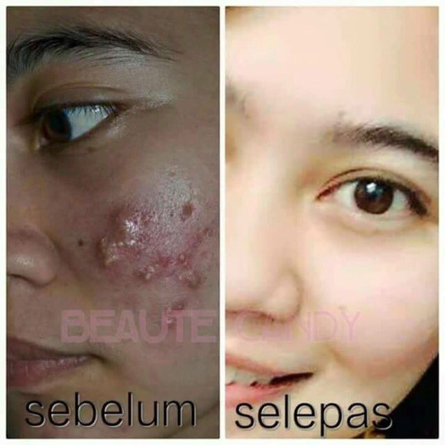 bihangirly's tweet photo. Nak putih gebu? Say no to injection. Nak cantik kulit putih kena la melabur. Jangan duduk diam tapi cakap nak kulit cantik https://t.co/UZ31HEJDZ5