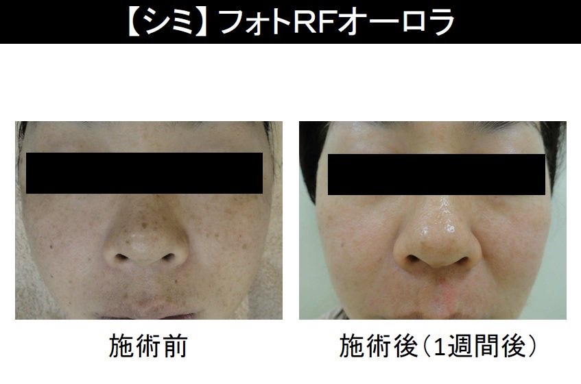 美容皮膚科ウォブクリニック中目黒 シミも取れてハリまでアップ おまけにダウンタイムもないなんて そんな夢のような治療が フォトrfオーロラ 昨日ご紹介した シミ取りレーザー はポイントのシミに有効なのに対して こちらはお顔全体に広がるシミに 美容皮膚科ウォブクリニック中目黒 シミも取れてハリまでアップ おまけにダウンタイムもないなんて そんな夢のような治療が フォトrfオーロラ 昨日ご紹介した シミ取りレーザー はポイントのシミに有効なのに対して こちらはお顔全体に広がるシミに