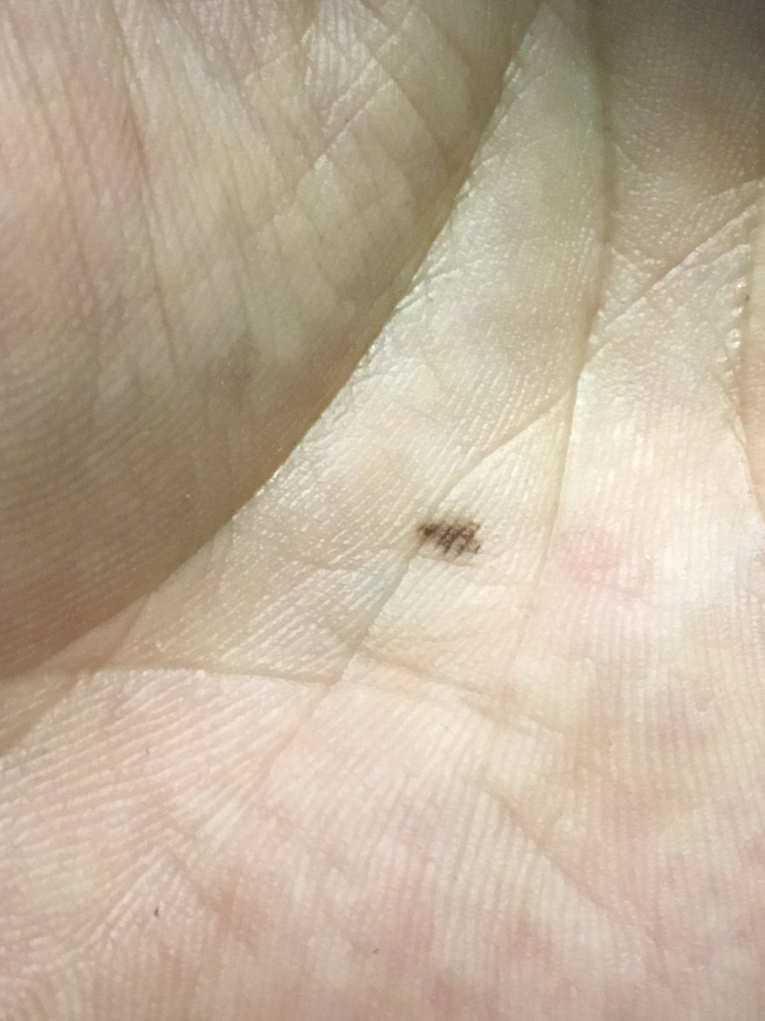 高須克弥 皮膚内に入った黒鉛はマクロファージに呑食されて少しずつ減少します タトゥーが褪せるのも同じ理由によるものです T Co Akflj08q8a Twitter