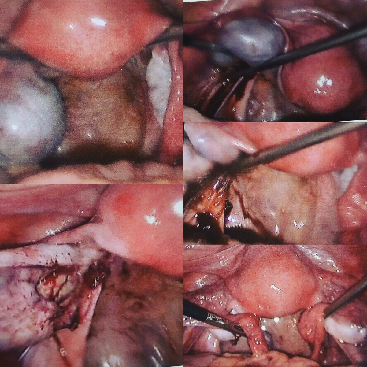 aatmadja's tweet photo. Laparoskopi pengangkatan kista endometriosis  indung telur kiri https://t.co/62s4tFPG1X