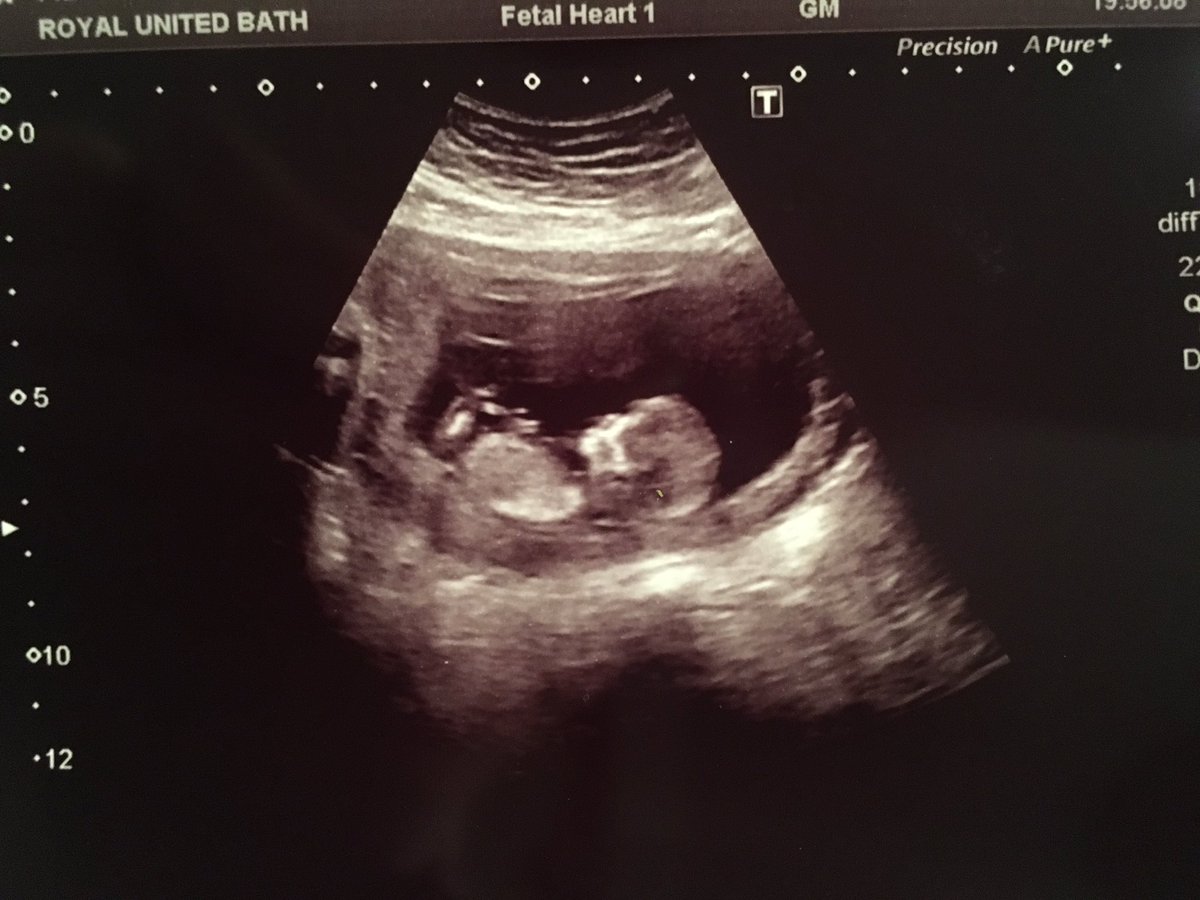 KeithM81's tweet photo. Time for a 2nd...😁👶🏻 #newdadagain https://t.co/h3r4TzDtdX