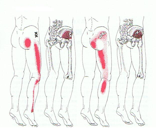 theNMTstudio's tweet photo. #tenderpoints vs #triggerpoints: What's the difference? #fibromyalgia #chronicpain #myofascialpain https://t.co/zOB9CQ9Eze