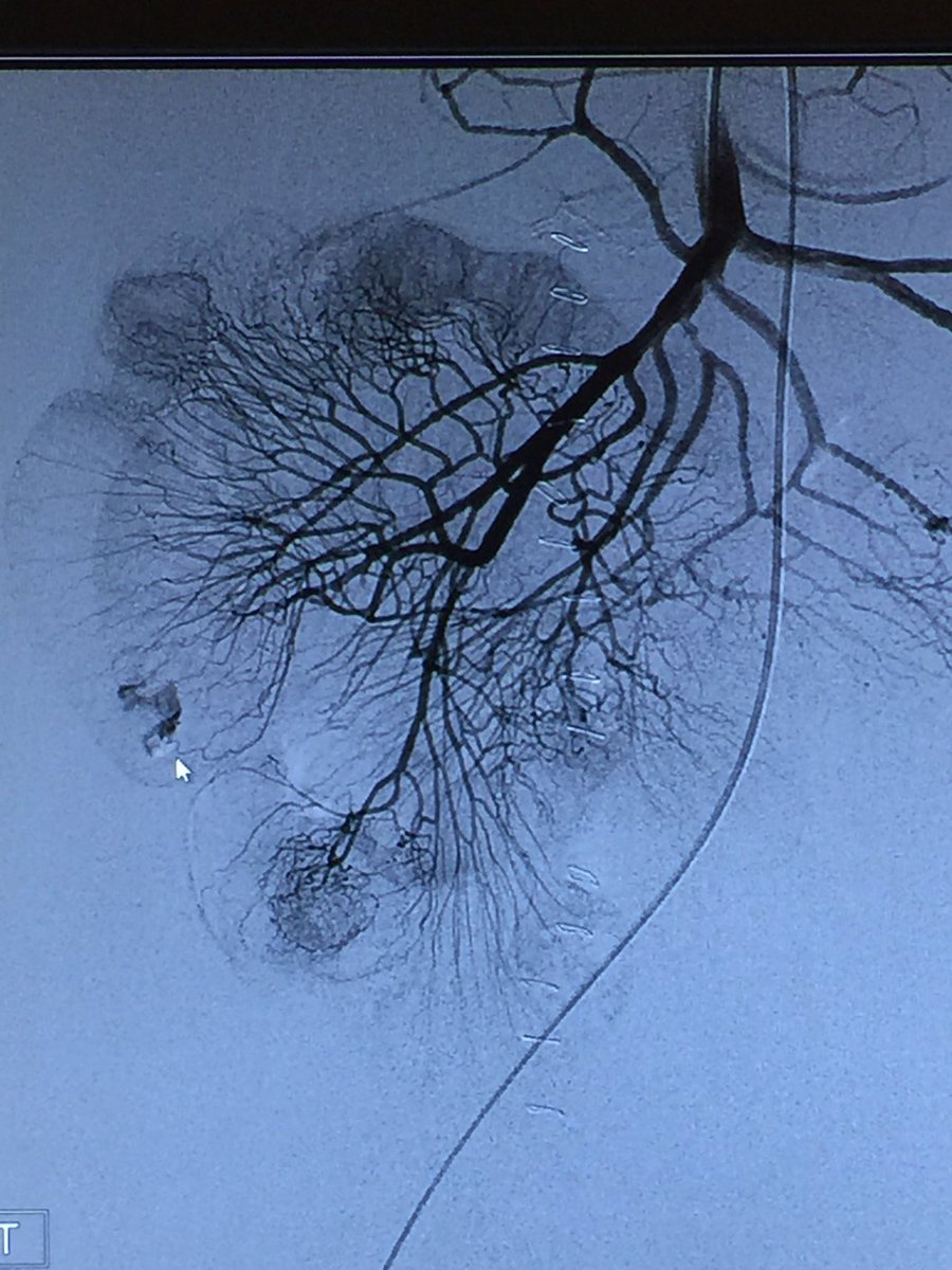 ahmed_kamel_ir's tweet photo. Post ileostomy Stomal bleed @uab_ir @mcbreamy @ajgunnmd @JVIRmedia @SIRRFS @amdevane @MUSCVIR @danbrownIO @LessneVIR https://t.co/bisw8qDUXI