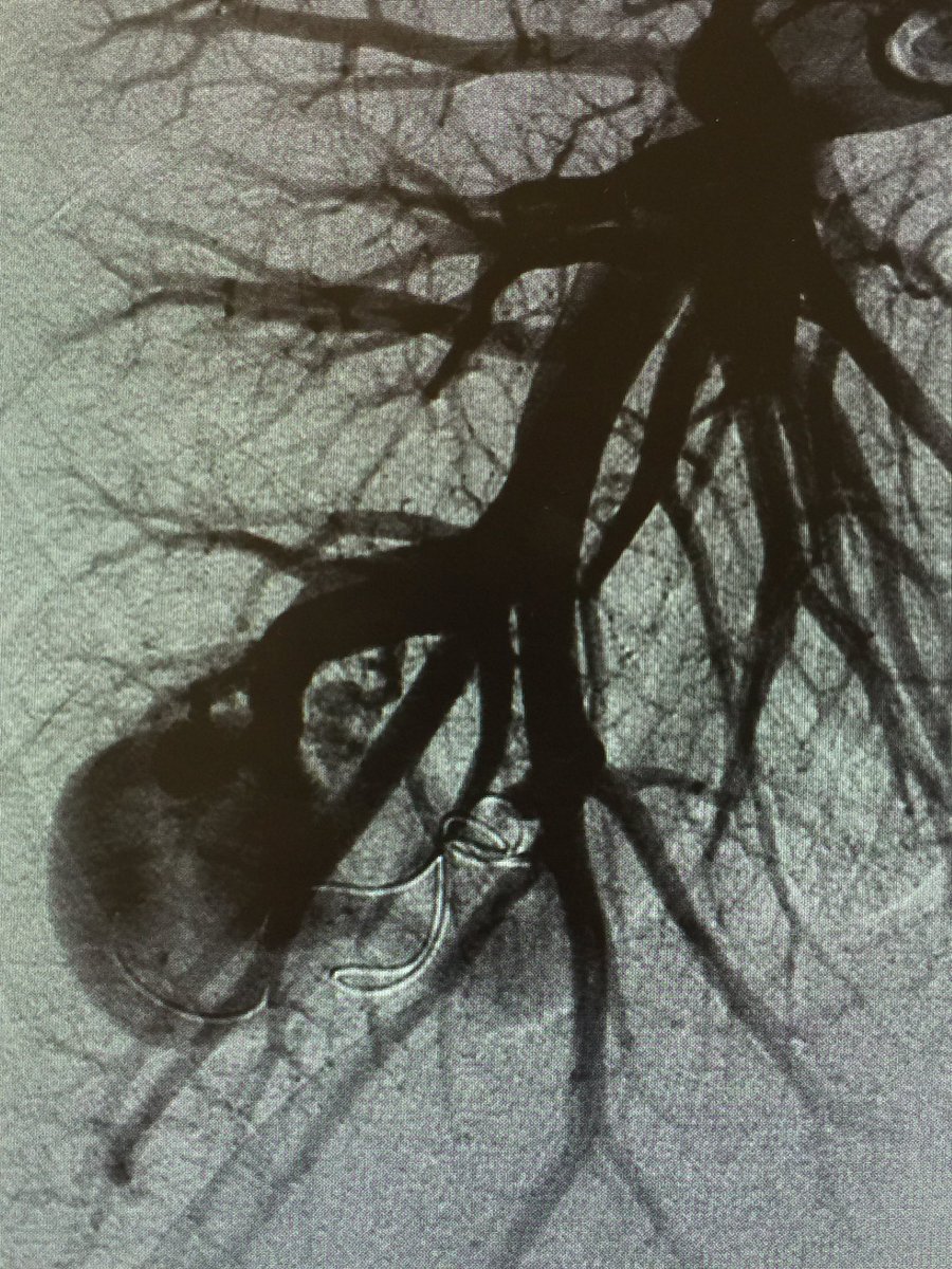ahmed_kamel_ir's tweet photo. Reperfused PAVM treated with AVP2 @danbrownIO @uab_ir @ajgunnmd @LessneVIR @mcbreamy @SIRRFS @amdevane @JVIRmedia https://t.co/tuHiAveSjU