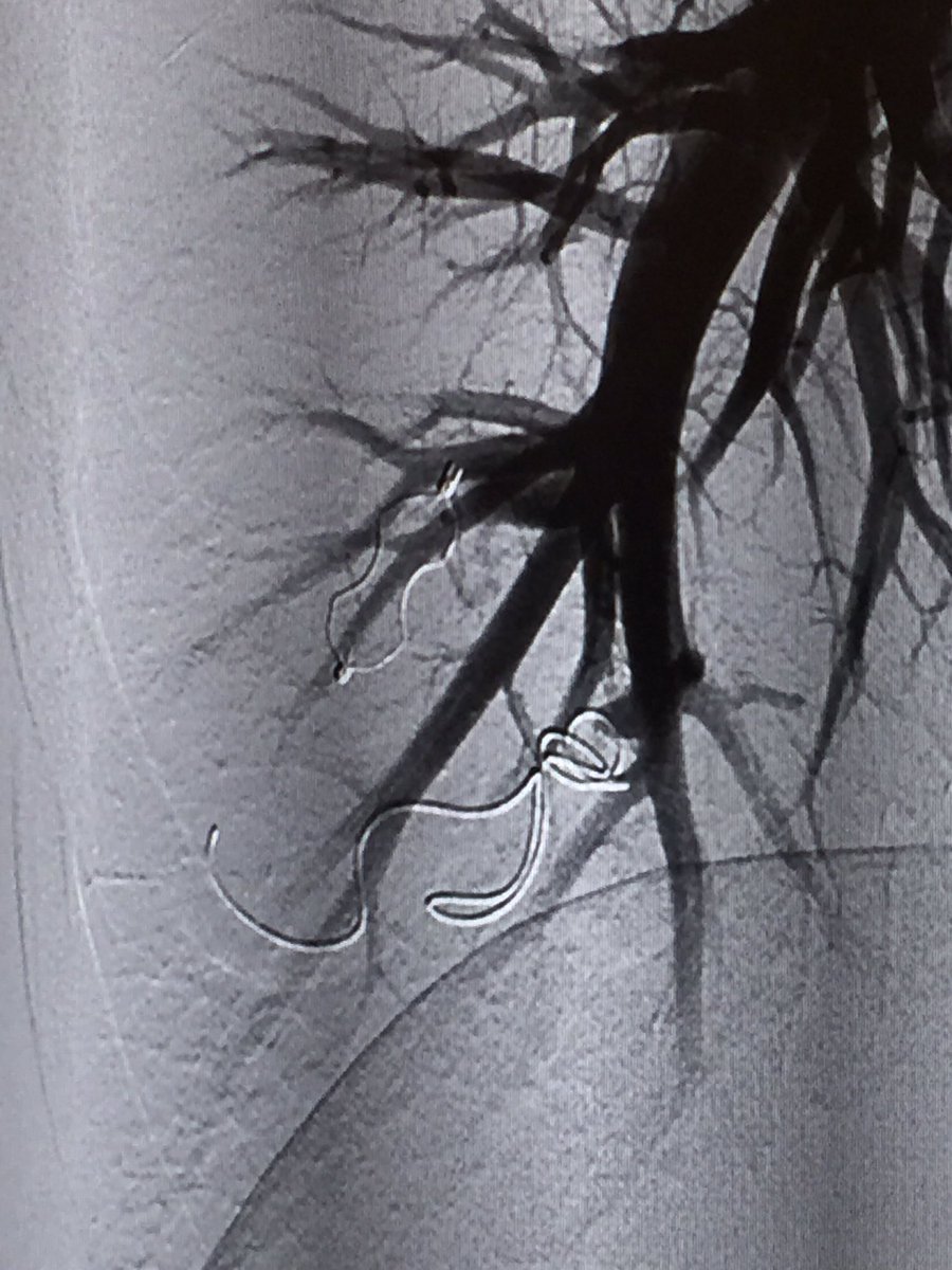 ahmed_kamel_ir's tweet photo. Reperfused PAVM treated with AVP2 @danbrownIO @uab_ir @ajgunnmd @LessneVIR @mcbreamy @SIRRFS @amdevane @JVIRmedia https://t.co/tuHiAveSjU