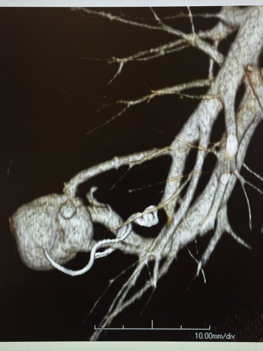 ahmed_kamel_ir's tweet photo. Reperfused PAVM treated with AVP2 @danbrownIO @uab_ir @ajgunnmd @LessneVIR @mcbreamy @SIRRFS @amdevane @JVIRmedia https://t.co/tuHiAveSjU