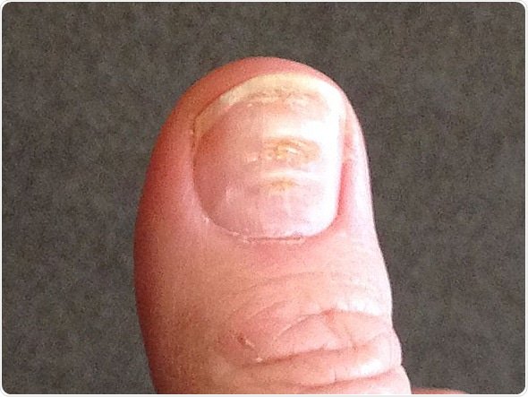 Dents in Fingernails: What Causes Them and How To Get Rid of Them - First  For Women