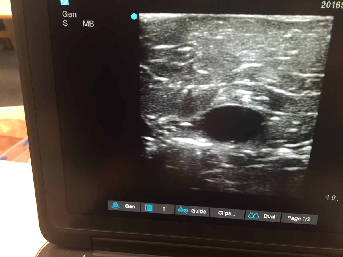 Terrific model for vascular access. Chicken &amp; balloons at the RAH GP trauma course #saasmedstar #rahtrauma