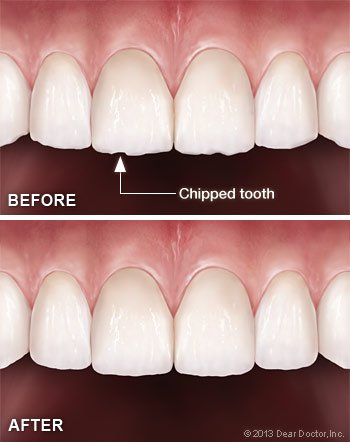 PariJMoazedDDS's tweet photo. Tooth Contouring &amp; #Reshaping. What to Expect?
https://t.co/M0GrNaTdxQ
 #WestminsterMD #dentist #toothcontouring https://t.co/6prvfZmTim