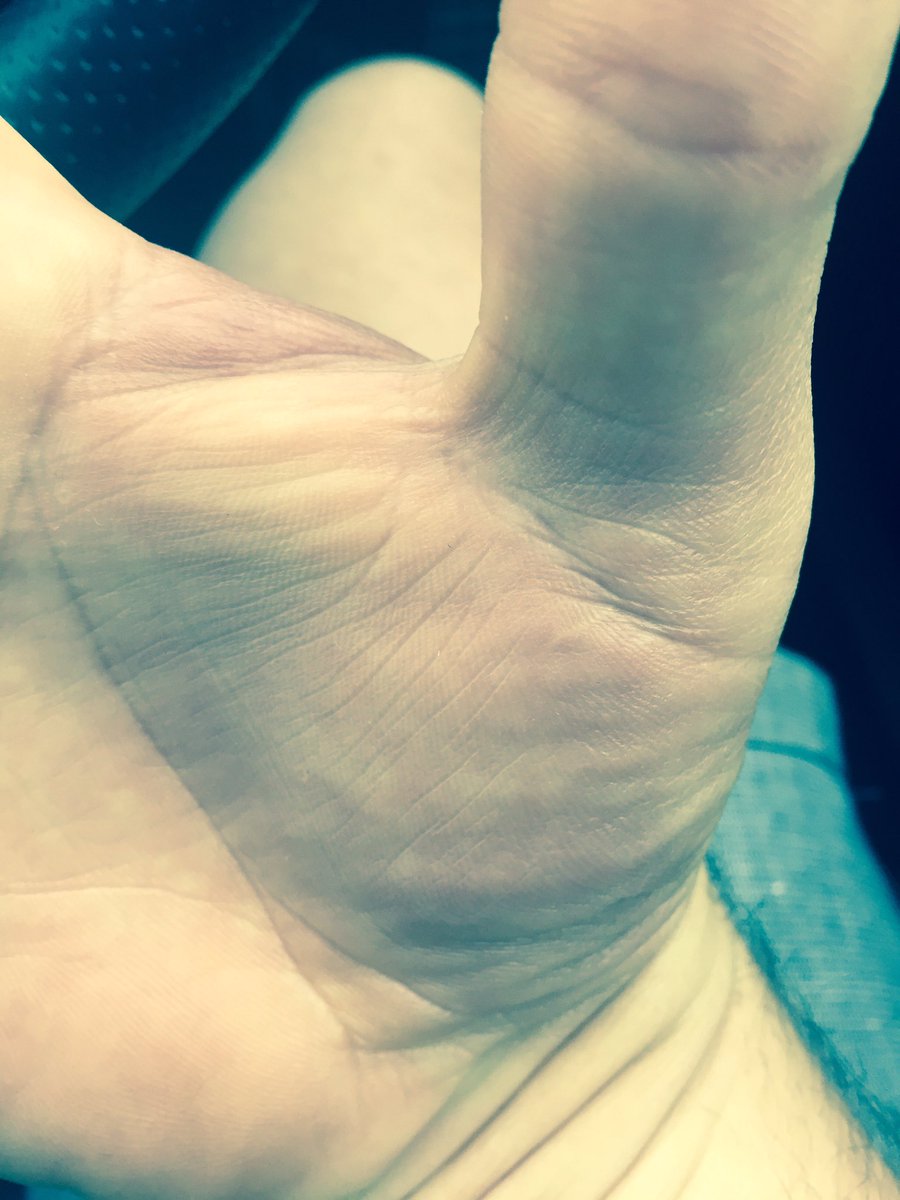 vincefreeman's tweet photo. Locking doors are dangerous! #dislocatedthumb #ouch https://t.co/gBivmhNVIR