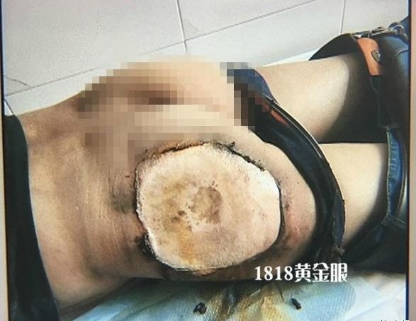 TechFission's tweet photo. Xiaomi Mi 4C catches fire and leaves third degree burns on Chinese man, after he returns from fruit shopping. https://t.co/1rHLv3J5lP