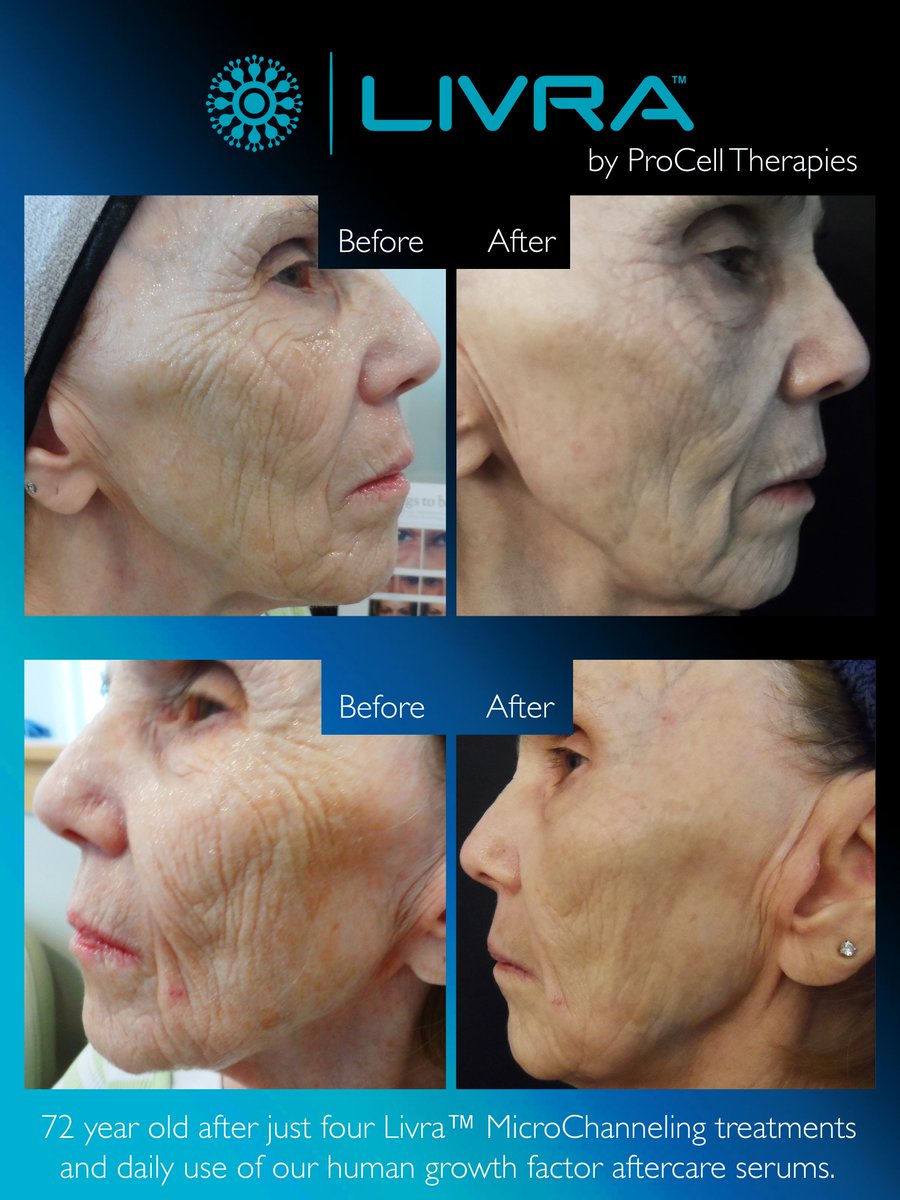 PCtherapies's tweet photo. At #LongBeachCongress? See how stem cell serums & MicroChanneling delivers AMAZING results. Discounts @ booth #253! https://t.co/D5aGV5m7if