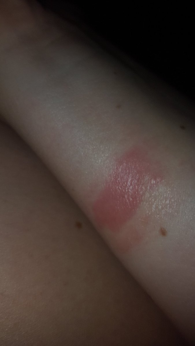 Jens_house's tweet photo. @FitbitSupport @FitbitUK burn from my fitbit!! I thought you solved this isue 😪 very sore can no longer use https://t.co/vE32TPBQMe