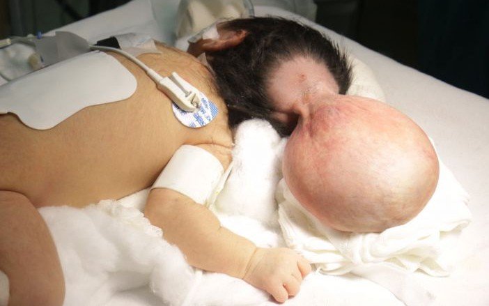 TabascoHOY's tweet photo. Exitosa cirugía en el Rovirosa a bebé tabasqueña con hernia a nivel cerebro
https://t.co/vJRYAp2M5L https://t.co/S3rRiRteeA