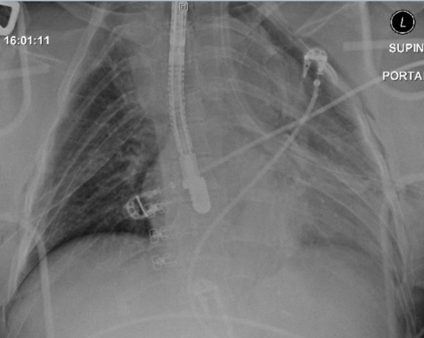 The next iteration of the FAST exam? TEeFAST
TEE for unstable trauma w susp aortic injury
dropbox.com/s/9na9kaf5m75m…