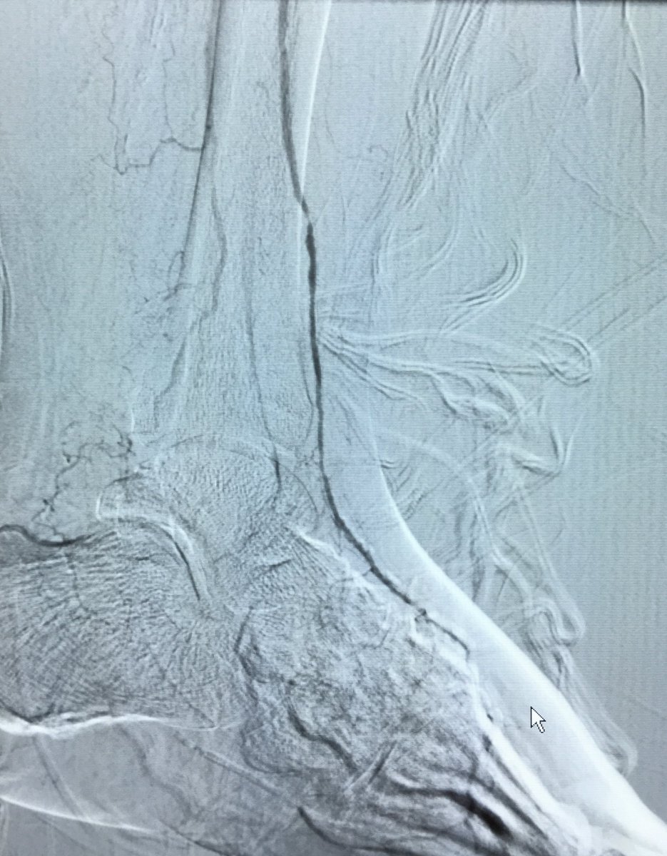 ABrandisMD's tweet photo. Sept-PAD awareness month! R BKA with L toe ulcers.B BKA's much more morbid. Zilver PTX SFA, PTA AT #InlineFlow #iRad https://t.co/YHmubazUbj