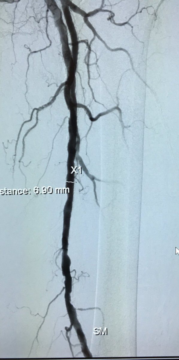 ABrandisMD's tweet photo. Sept-PAD awareness month! R BKA with L toe ulcers.B BKA's much more morbid. Zilver PTX SFA, PTA AT #InlineFlow #iRad https://t.co/YHmubazUbj