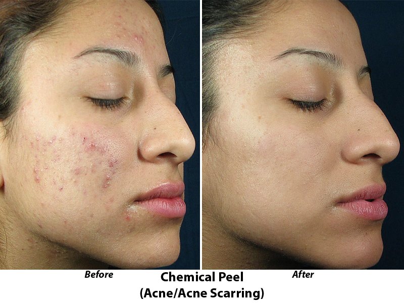 face peel clinic
