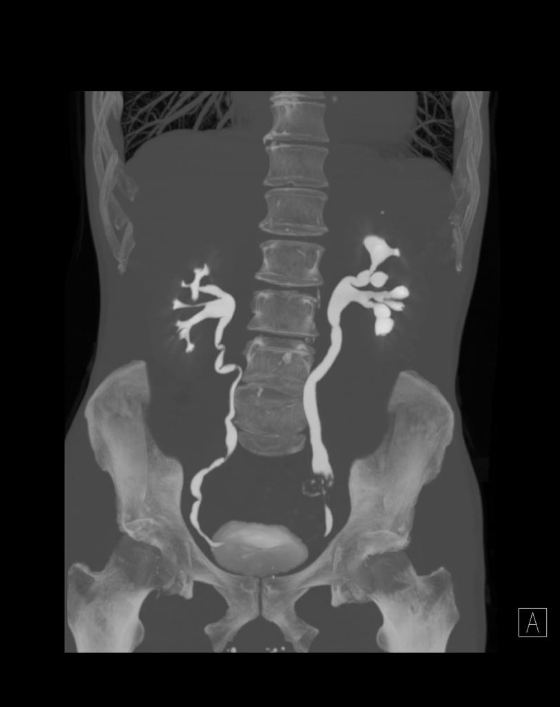 ramiro_cabello_'s tweet photo. #tumor #urotelio #ureter izquierdo. #nefroureterectomia #laparoscopia #retroperitoneal Vs #transperitoneal @InfoAeu https://t.co/v5ZUNmDdw2