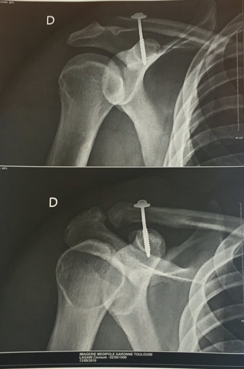 L'opération s'est bien déroulé, un coup de visseuse et ça repart! 😅💪🏽 #epaulebionique