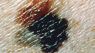 dermPA's tweet photo. #SpitzNevi or #Melanoma? Can Reflectance Confocal Microscopy Help? | #Derm #DermPA | https://t.co/Rh9FzR4rQZ https://t.co/5EGjifjGPe