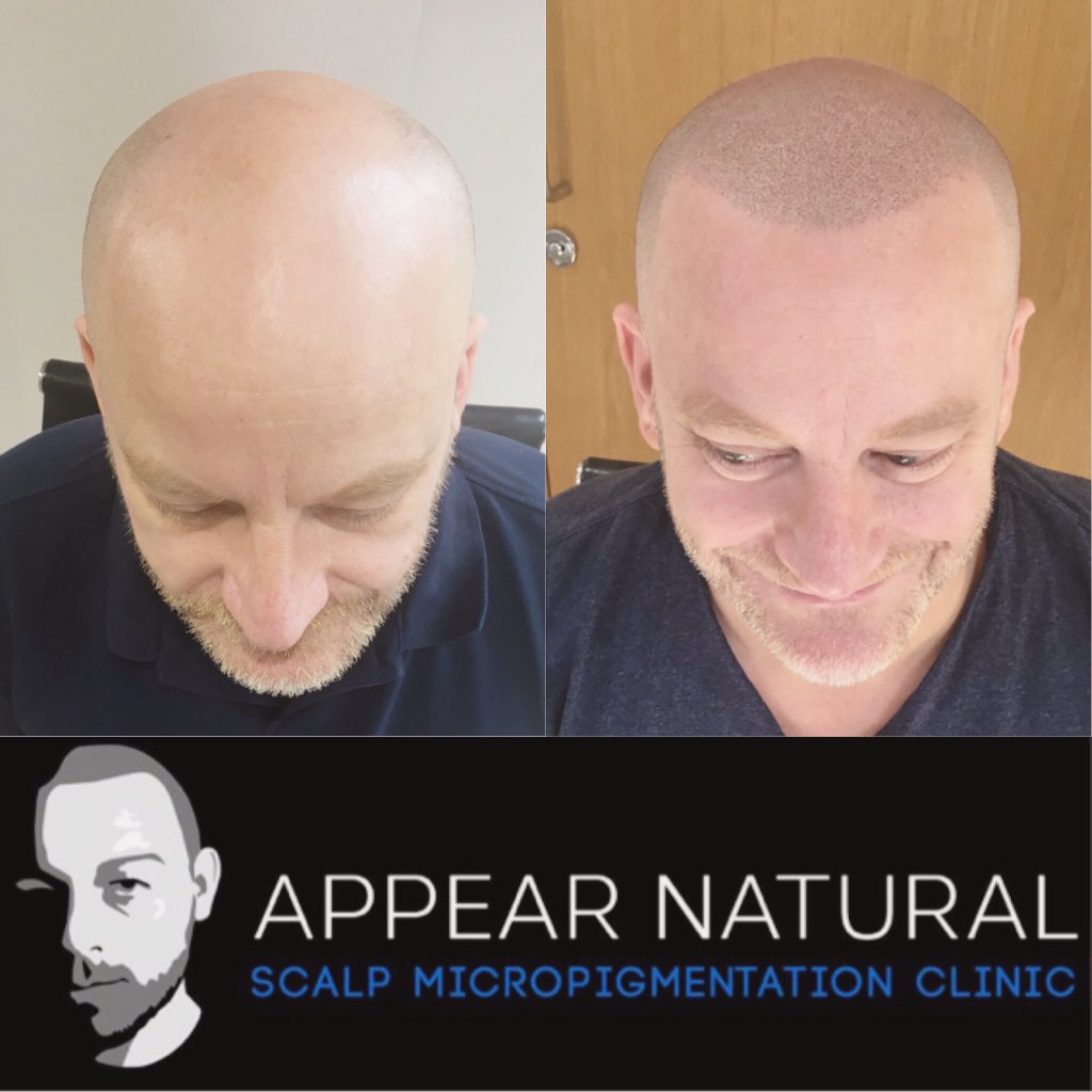 AppearN's tweet photo. Forget about hair loss! Get in touch with Appear Natural on 02037222338 @BeckBromFL @WoW_Bromley https://t.co/VTSO3zIAAy