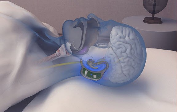 SnapMunk's tweet photo. With a mic, some nerve stimulation and some time, @SnoreCircle could cure your noisy nights https://t.co/u19jIkg2vu https://t.co/DktFIHye7k