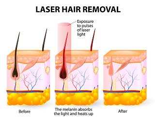 UVInow's tweet photo. Electrolysis vs. Laser hair removal
#electrolysis #laserhairemoval
https://t.co/YCkejiOj5o https://t.co/vrSc9zj41w