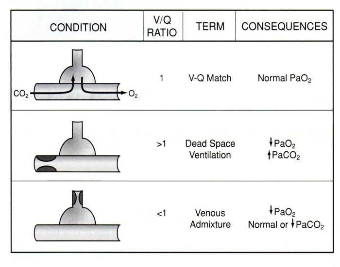 PA_Maday's tweet photo. Key principle in differentiating causes of respiratory failure is:
The V/Q Ratio
#PANCE https://t.co/aKqo37FfSE