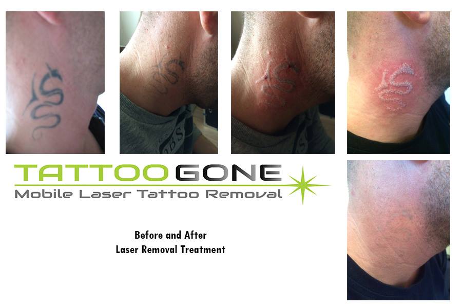 TattooGoneKent's tweet photo. Book your session now #TattooGone #TattooGoneKent #Lasertattooremoval #unwantedink #mobiletattooremoval #inkgone https://t.co/m8FluFrrM4