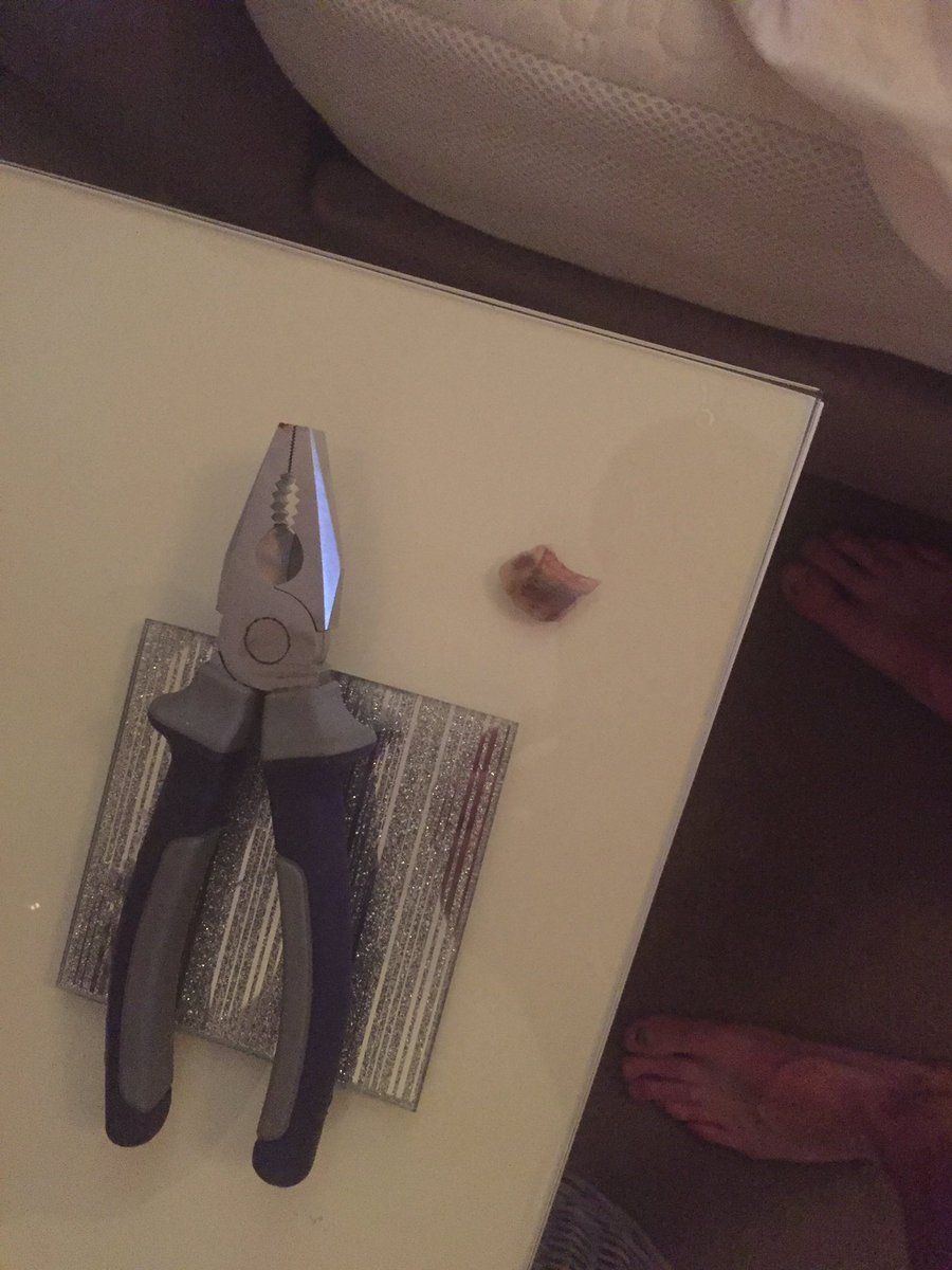 Tommaguire1986's tweet photo. Successful cricket season done with a @UptonCC promotion, so only one thing to do. #removethenail #bowlerproblems https://t.co/F2YS4gnjOI