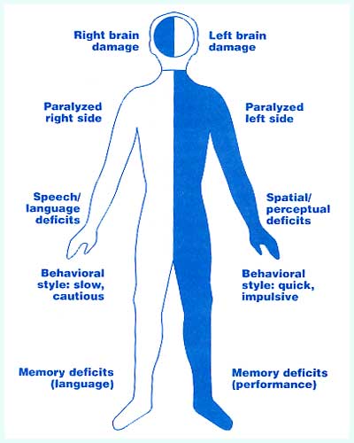 thecarekids's tweet photo. Know what are the effects of a stroke #strokeknowhow #strokesurvivor #strokeorganization #strokerecovery https://t.co/HnMvKabQsk
