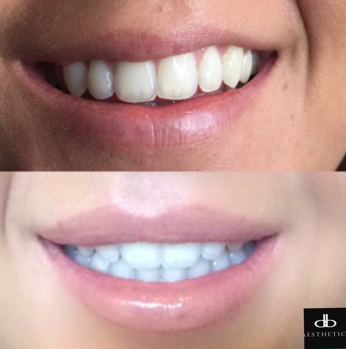 AestheticsDb's tweet photo. #lipcorrection replacing the missing volume of the clients left handside using 1ml #dermalfiller #bestlips 👌🏼👄 https://t.co/daEmnXZQXR