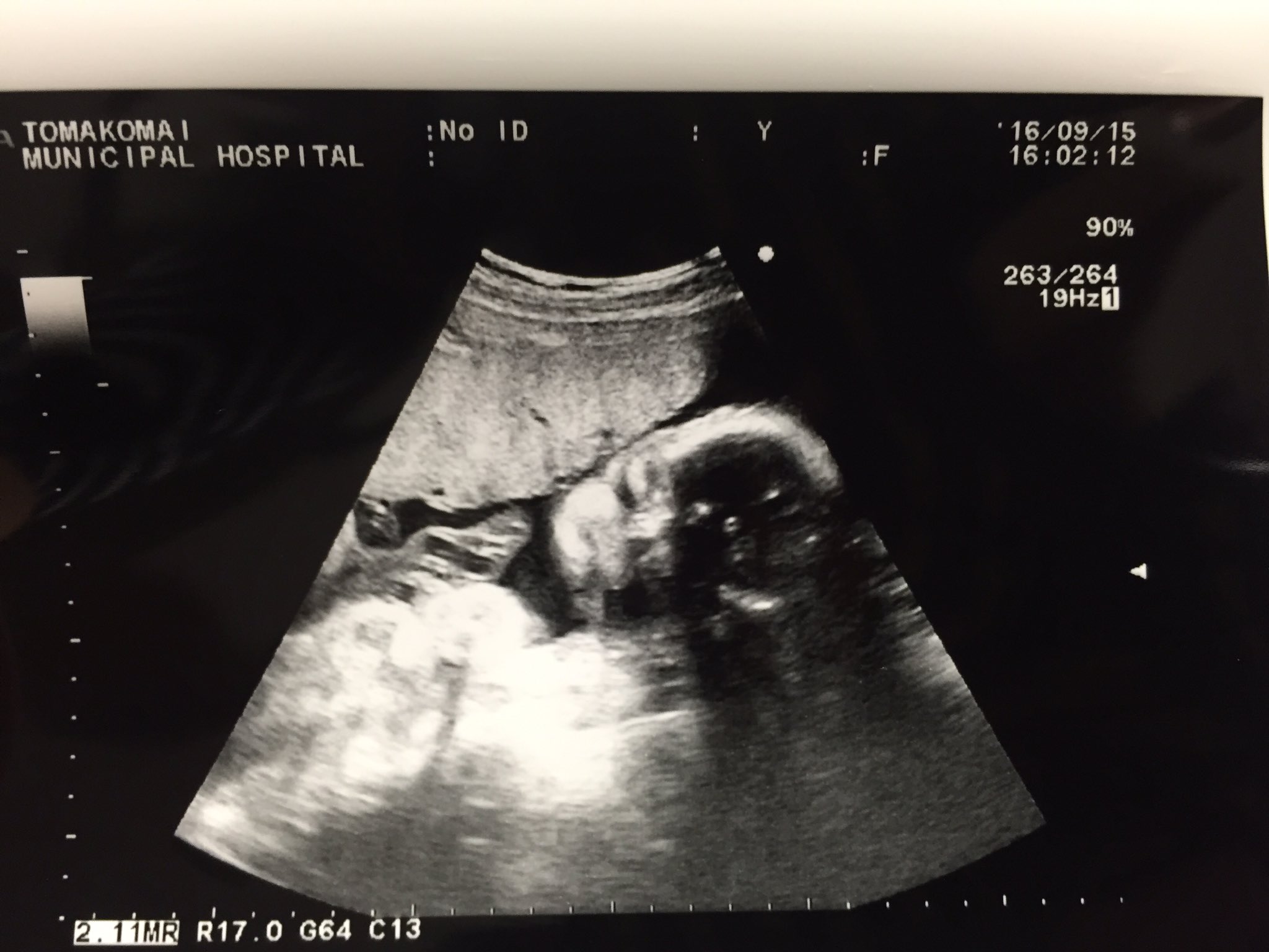 いましゅん 妊娠8ヶ月 エコー見てる時にまさかのベイビーちゃんがあくびしてくれた かわいっ T Co J4gjxc0eje Twitter いましゅん 妊娠8ヶ月 エコー見てる時にまさかのベイビーちゃんがあくびしてくれた かわいっ T Co J4gjxc0eje Twitter
