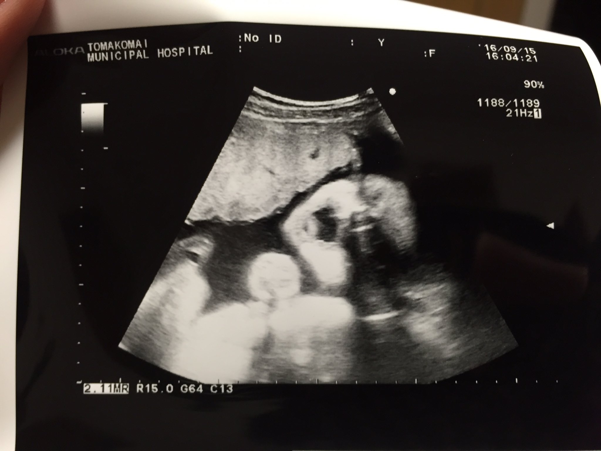 Twitter 上的 いましゅん 妊娠8ヶ月 エコー見てる時にまさかのベイビーちゃんがあくびしてくれた かわいっ T Co J4gjxc0eje Twitter