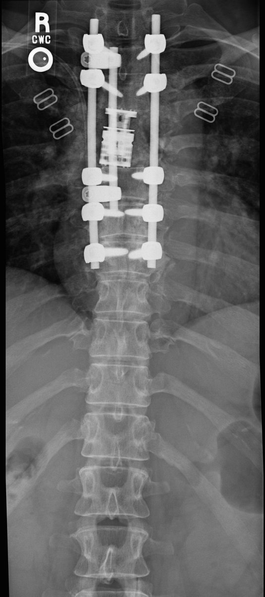 athleteonchemo's tweet photo. @BBethJo these pictures provoke such empathetic pain. here are pics from my spine surgery in July 2014 https://t.co/1YzDL2MaJ7