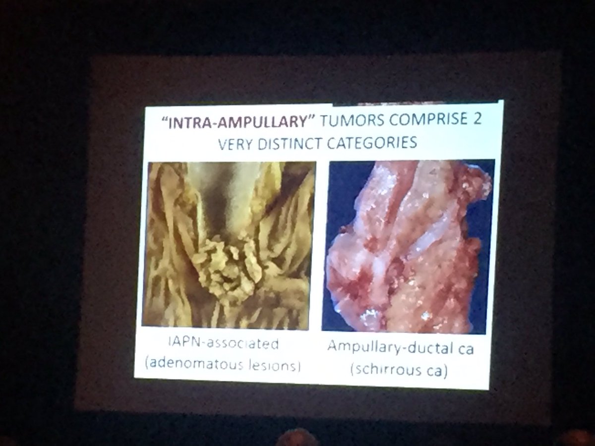 aakasharmand's tweet image. Dr Adsay - intra-ampullary tumors #PathLab2016