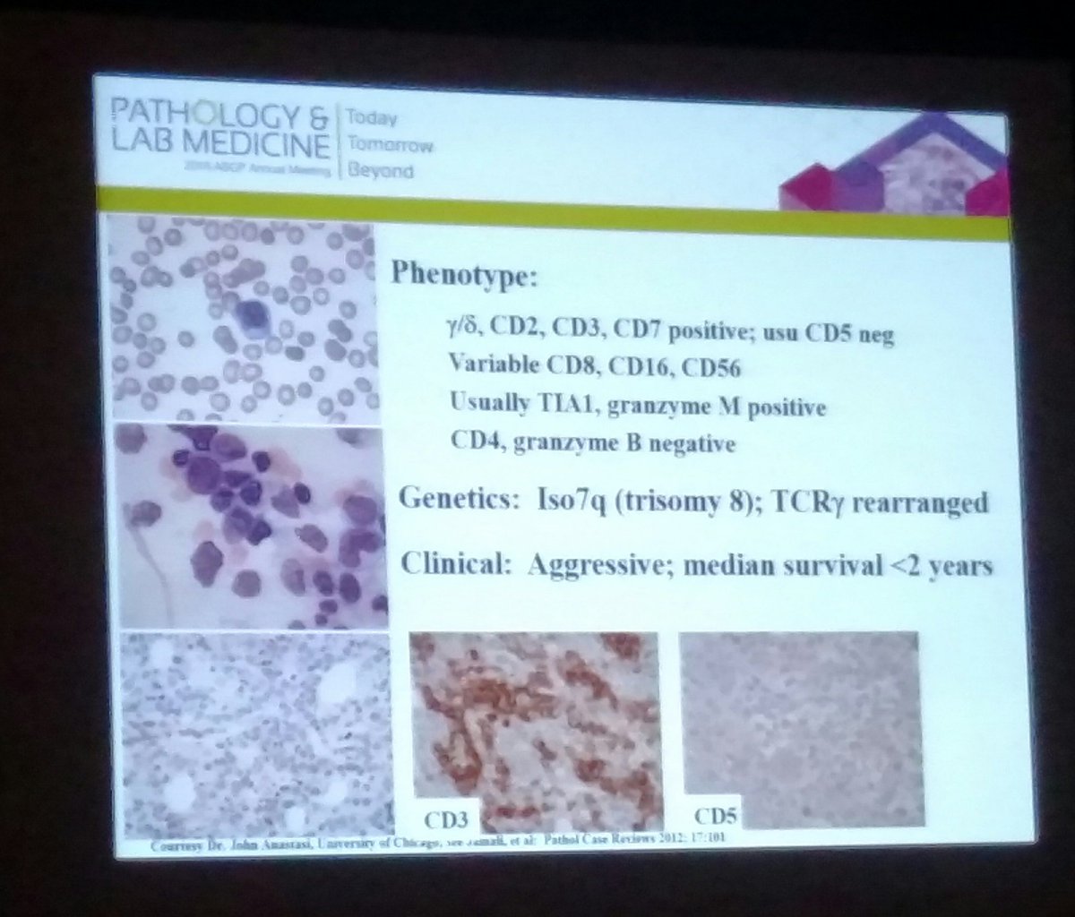 BettyMChung's tweet image. Hepatosplenic TCL granzyme M but B neg #PathLab2016 #hemepath