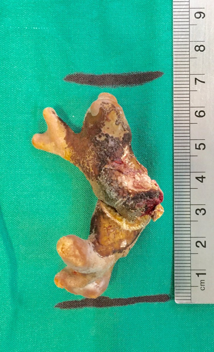 navidmahar's tweet photo. This is wat I Managed to remove by #Pyelolithotomy frm an Intrarenal pelvis!!
#StoneBelt @Uroweb #urojc @BJUIjournal https://t.co/1HWoUgm5lK