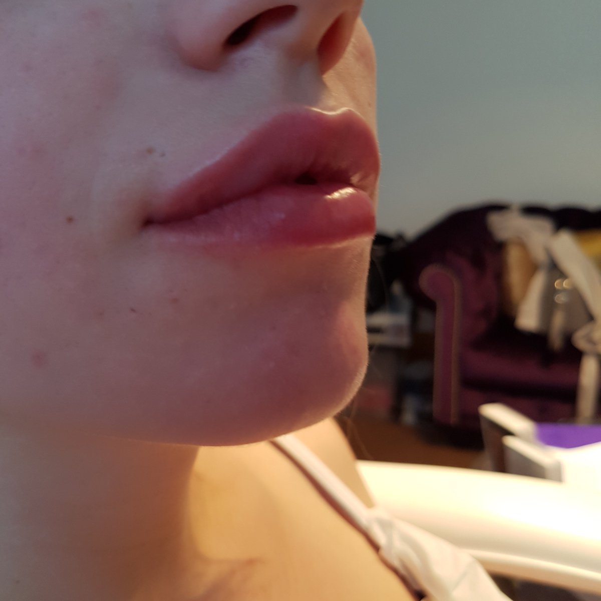 Stunning lips by pHskin Cosmetic Clinic #lips #pout #lipfiller