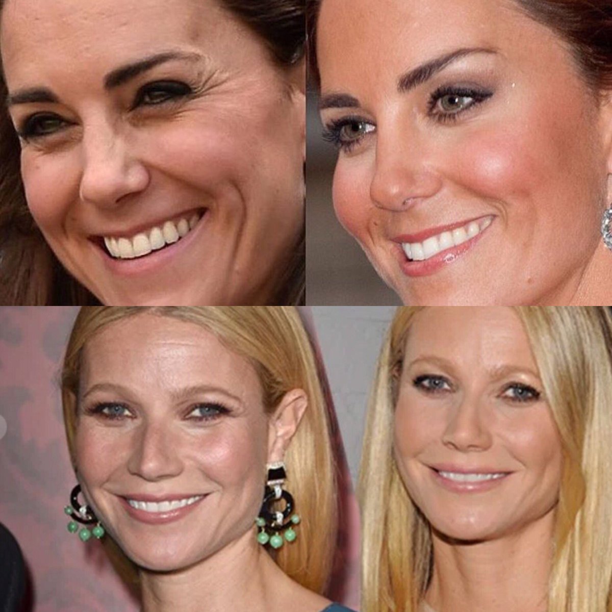 ShethDerm's tweet image. Kate Middleton and Gwenth Paltrow are prime examples of what Botox and fillers can do! Book your appointment today!